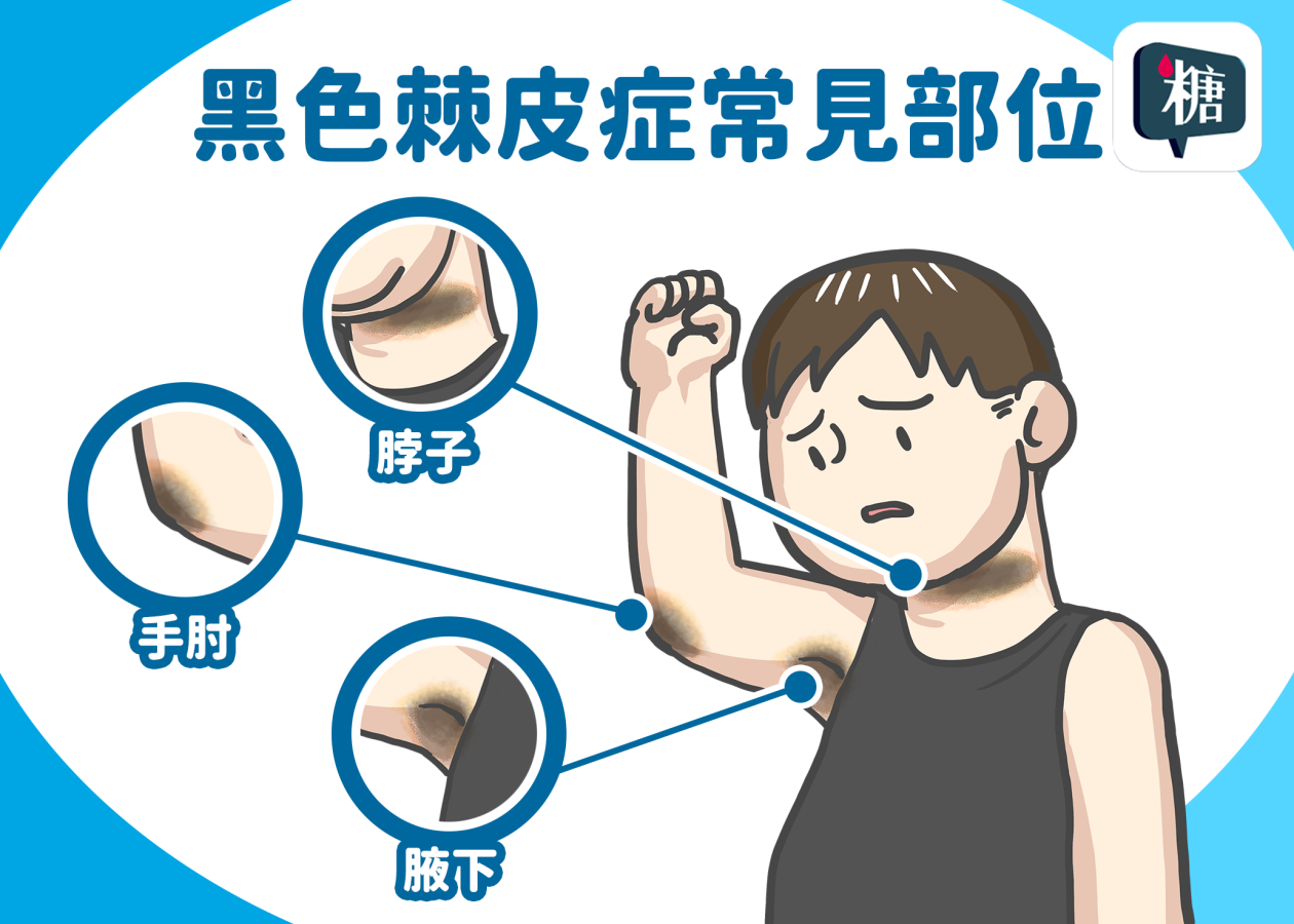圖1糖尿病前期徵兆示意圖.png