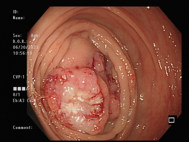 圖1大腸鏡檢查發現患者於升結腸有一大小約3公分的潰瘍性腫瘤切片結果顯示為大腸癌.jpg