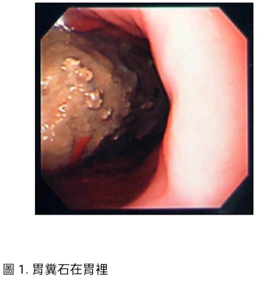 圖1胃糞石在胃裡.jpg