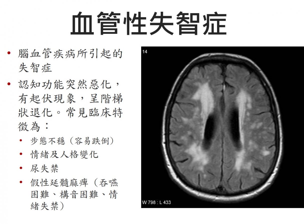 圖1血管性失智症1.jpg