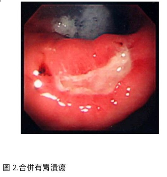 圖2合併胃潰瘍.jpg