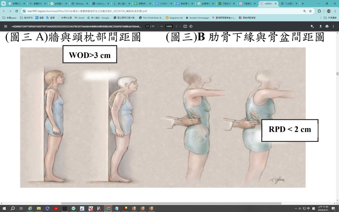 圖3WOD和RPD-牆與枕部間距wall-occipital_distanceWOD和肋骨下緣與骨盆間距_rib-pelvis_distanceRPD.jpg